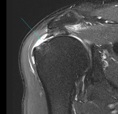 회전근개 파열의 MRI 사진