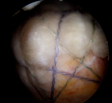 관절경 기법을 통한 회전근개(극상건) 봉합술 후 사진